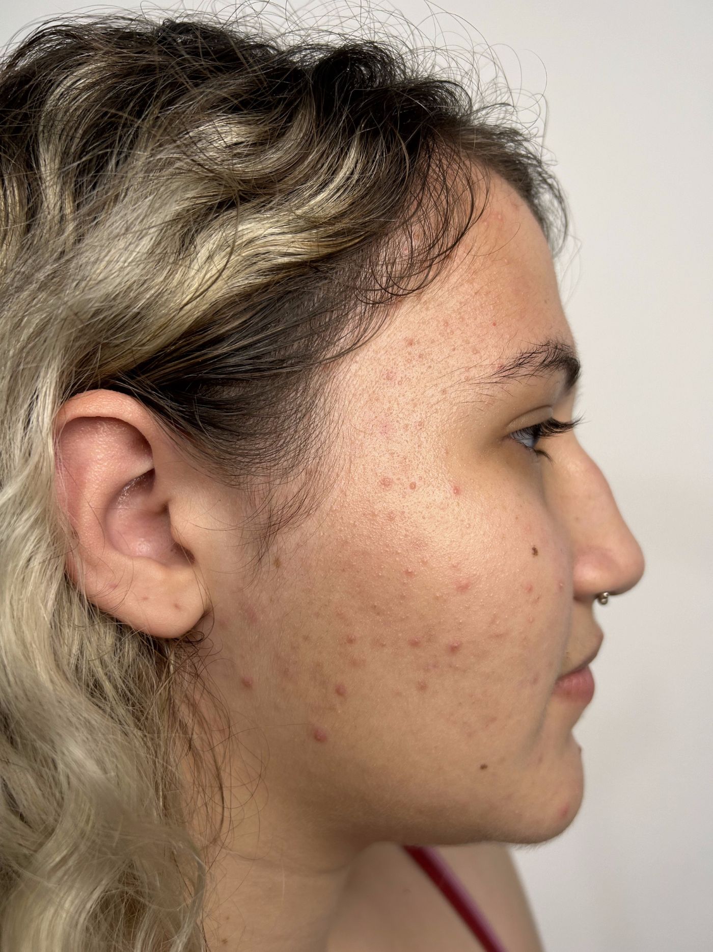 roza_resultado_antes