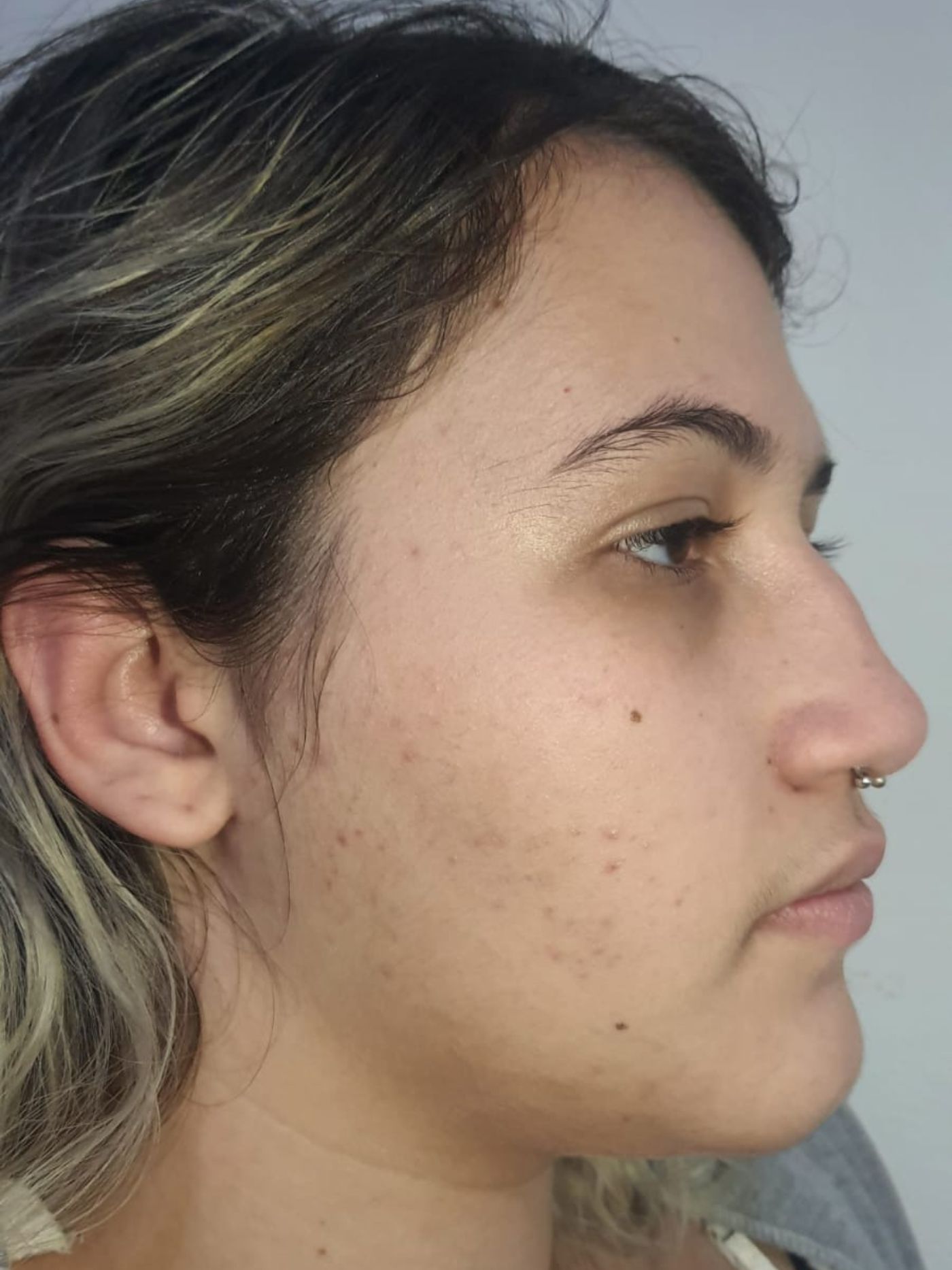 roza_resultado_depois2